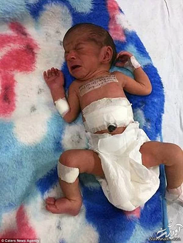تولد نوزاد عجیب دو سر تولد نوزاد عجیب